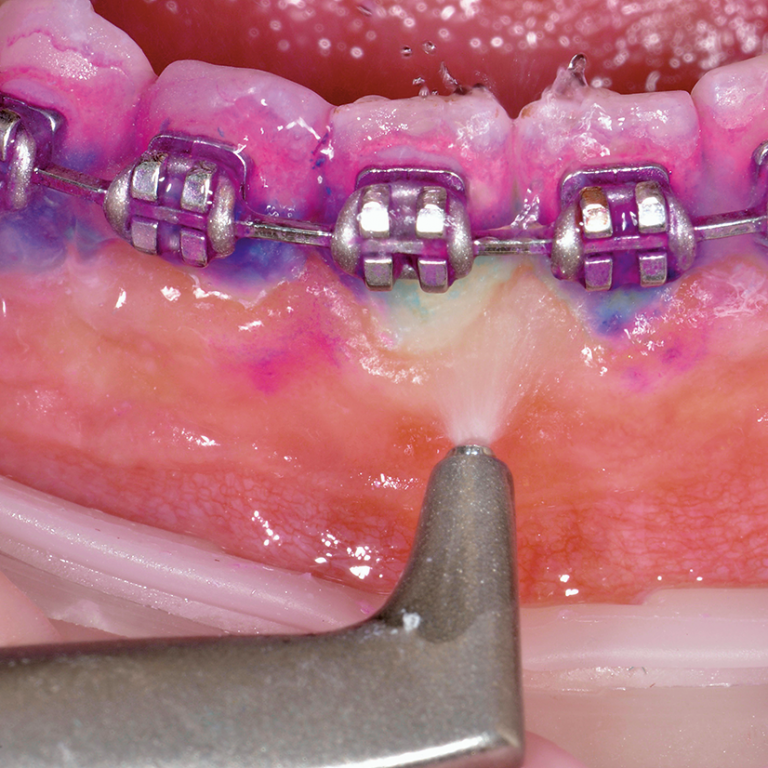 Airflow on orthodontics 1 x 1
